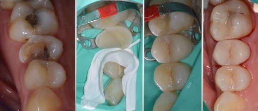 Rekonstrukce zubu